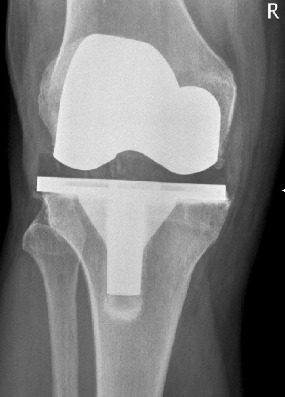 Knee joint implant X-ray